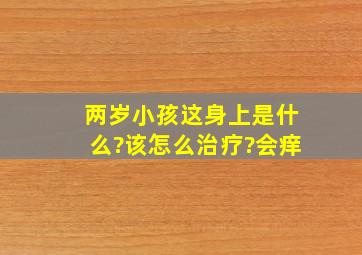 两岁小孩这身上是什么?该怎么治疗?会痒