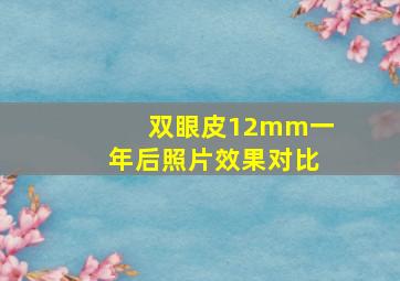 双眼皮12mm一年后照片效果对比