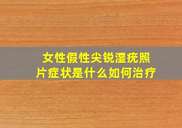 女性假性尖锐湿疣照片症状是什么如何治疗