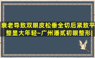 衰老导致双眼皮松垂,全切后紧致平整显大年轻~广州潘贰初眼整形|重睑...